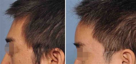 Asian Forehead Augmentation Result Side View Dr Barry Eppley