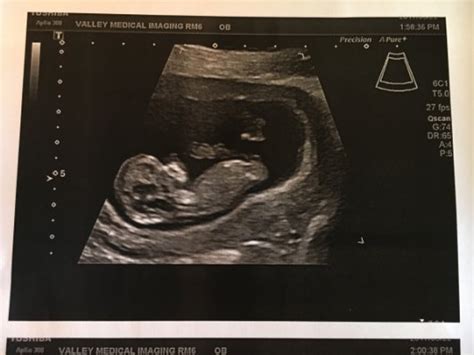 11 Weeks Pregnant Ultrasound 11 Week Ultrasound 3 Chadsellers