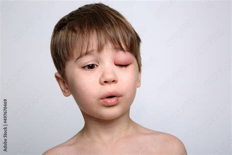 Child With Red Swollen Eye From Insect Bite Quincke Edema Portrait Of
