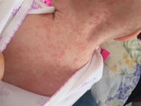Cashew Allergy Skin Rash Babies Sekagot