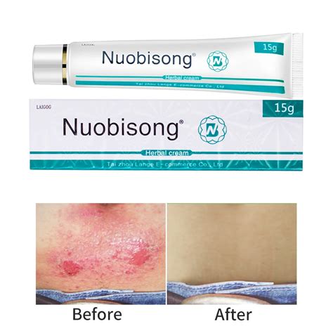 15ml Nuobisong Face Skin Care Treatment Face Pimples Scar Stretch Marks Removal Acne Treatment