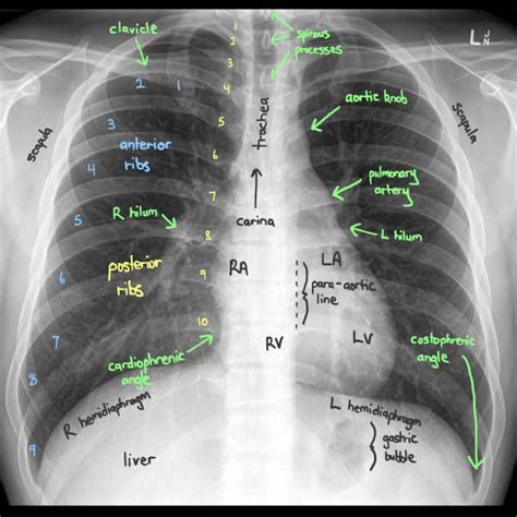 Normal Chest X Ray Labeled
