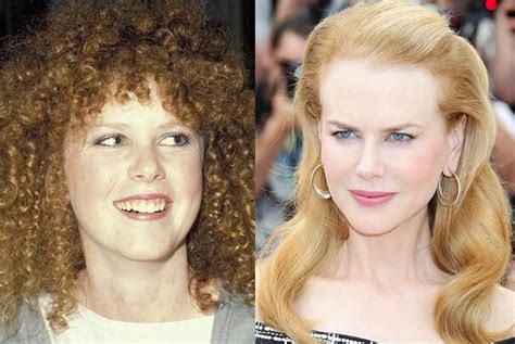 Nicole Kidman Before And After Plastic Surgery Celebrity Plastic