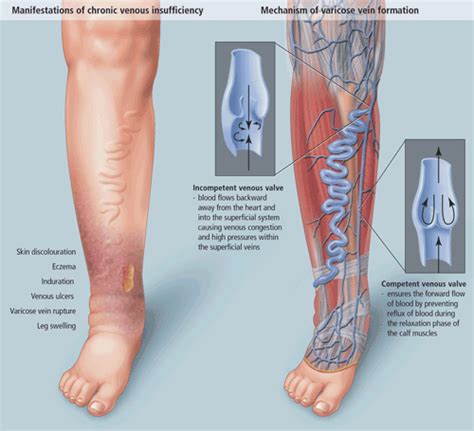 Spider And Varicose Vein Treatments Vascular Surgery Ulceras