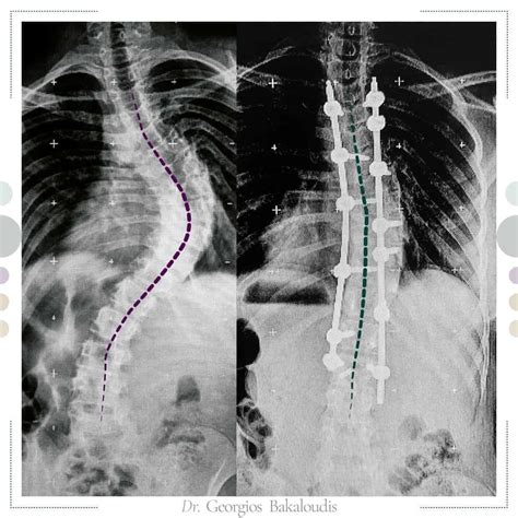 Scoliosi Tipologie Cause Sintomi Percorso Di Cure E Intervento