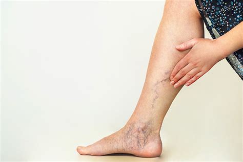 Get A Leg Up On Varicose Veins Mayo Clinic Health System