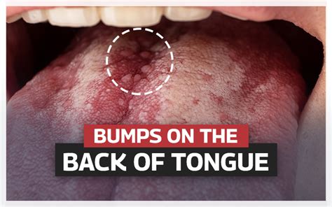 White Tongue With Red Bumps On Back Of Tongue White Bumps On Back My