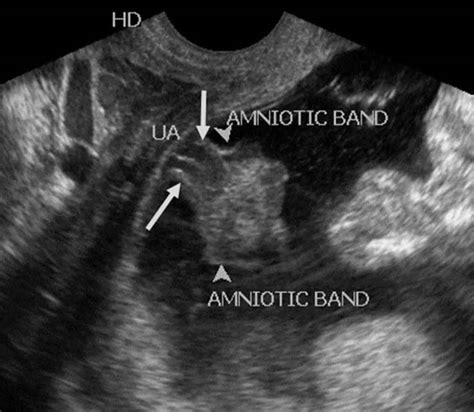 Amniotic Band Syndrome Causes Symptoms Diagnosis And Treatment