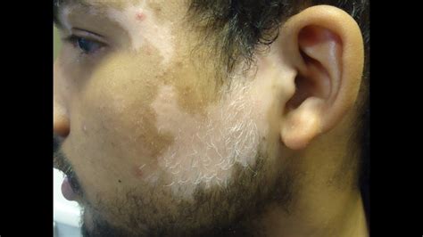 How To Cure White Spot On Skin Vitiligo Treatment Naturally Youtube