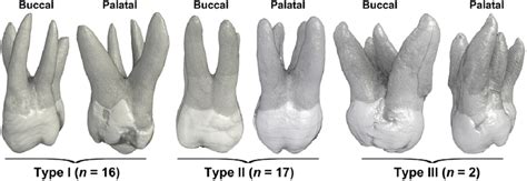 Buccal And Palatal Views Of 3d Reconstruction Of 3 4 Rooted Maxillary