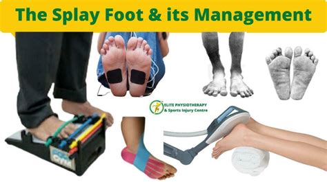 The Splay Foot And Its Management
