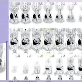 F Fluoro Methyl Choline Fmc Positron Emission Tomography Computed