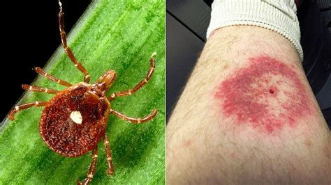 7 Tick Bites That Can Make You Sick Everyday Health