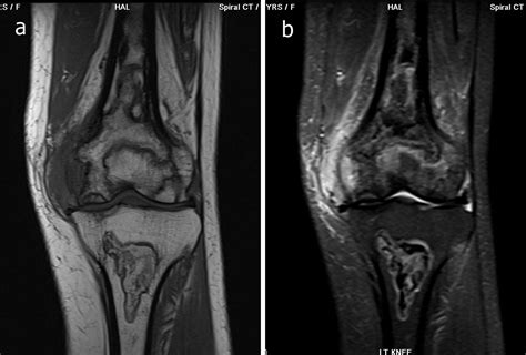 Radiodiagnosis Imaging Is Amazing Interesting Cases Bone Infarct Mri