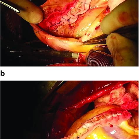 Ct Scan Brain 11 Months Postoperative Open Heart Surgery Download