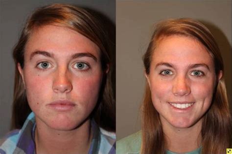 Cosmeticrhinoplasty1 Kalos Facial Plastic Surgery