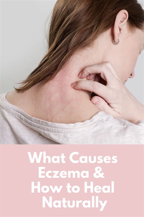 4 Eczema Triggers That You Need To Know About Artofit