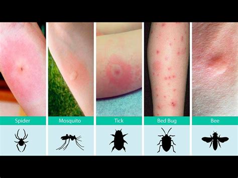 Pictures Of Bed Bug Bites Vs Mosquito Bites Peepsburghcom