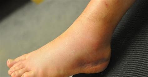Maybe you would like to learn more about one of these? ANKLE SPRAIN : GRADES; CAUSES AND TREATMENT |FINDYOURSELF ...