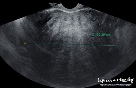단일공 선근증자궁의 자궁내막증근종 자궁의 부분 절제술 네이버 블로그