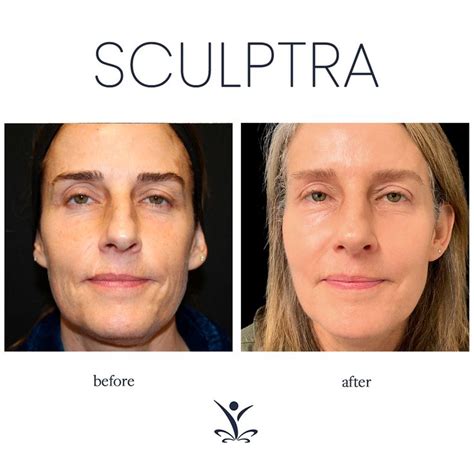 Before And After Sculptra Face Fillers Sculptra Aesthetic Chemical Peel