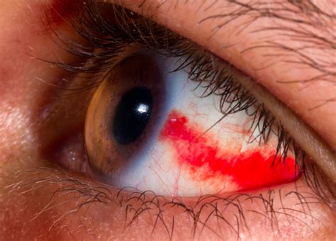 Recurring Broken Blood Vessel In Eye