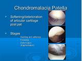 Photos of Patellofemoral Chondromalacia Treatment