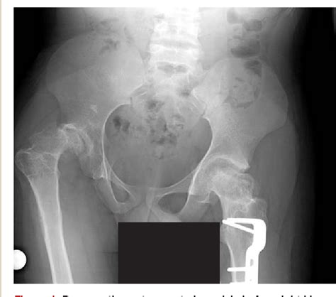 Pantaloon Hip Spica Cast And Constrained Liner For The Treatment Of Early Total Hip Dislocation