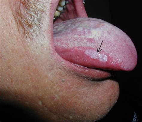 Noticing black spots on your tongue or other types of dark patches in your mouth can cause you to worry. Health Teller: White Spots on Mouth Mucosa