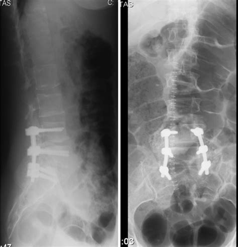 Coluna Lombar L1-l4 Osteopenia