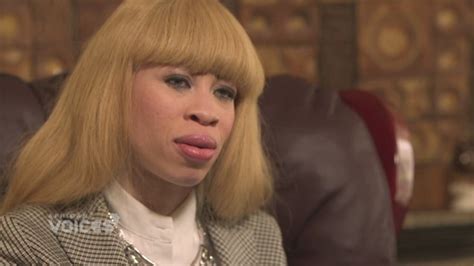 Malawis Albinos At Risk Of Total Extinction Un Warns