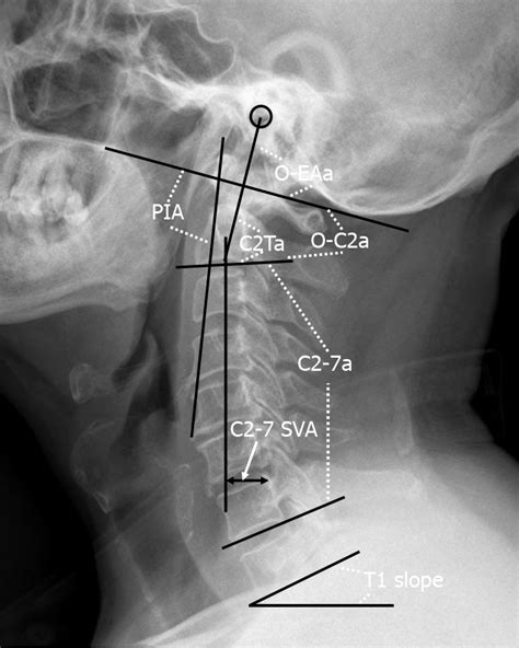 Sequential Sagittal Alignment Changes In The Cervical Spine After
