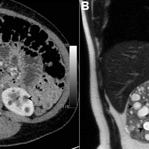 Autosomal Dominant Polycystic Kidney Disease Adpkd A A 39 Year Old
