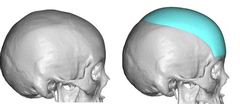 Custom Forehead Skull Implant Design Side View Dr Barry Eppley