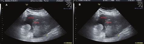 Ultrasound Images Of Ascites A Transabdominal Ultrasound Image