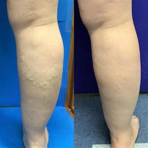 Before And After Vein Treatment Photos Vein Specialists Of The Carolinas