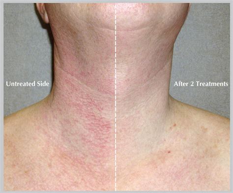 Bbl Hero Before And After Dr Cynthia Golomb