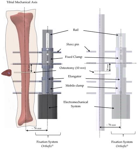 Applied Sciences Free Full Text Evaluation Of Bone Consolidation In