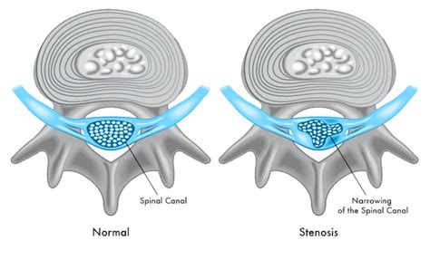 Foraminal Stenosis Minnesota Spine Institute