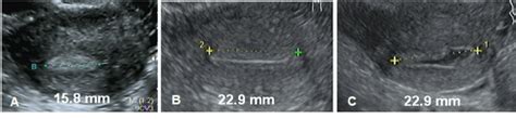 A Multicenter Study Assessing Uterine Cavity Width In Over Nulliparous Women With Iud Or
