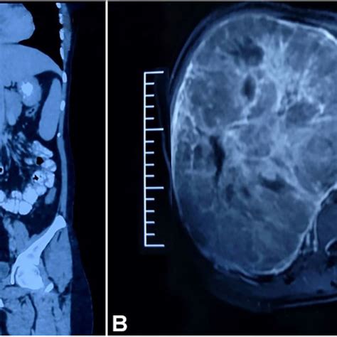 A And B Pet Ct Showing Large Fdg Avid Heterogeneously Enhancing