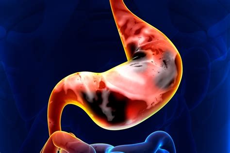 Hemorragia Digestiva O Que Causas Sintomas E Tratamentos Cannalize