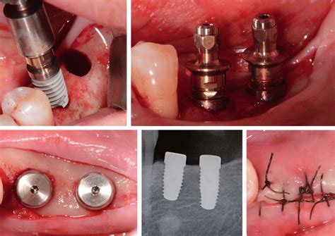 Dental Implant Placement Surgery Nos 20 And 21 Download