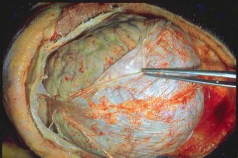Discover symptoms · how meningitis spreads · learn who's at risk Meningitis - pneumococcal. Causes, symptoms, treatment ...