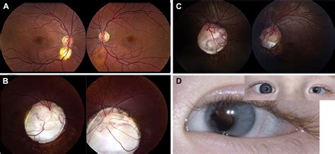 Joubert Syndrome Ophthalmological Findings In Correlation With