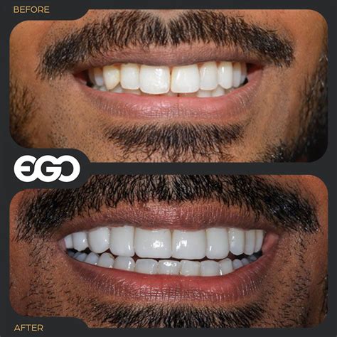 Maybe you would like to learn more about one of these? Veneers - EGO Dental Clinic Westminster London