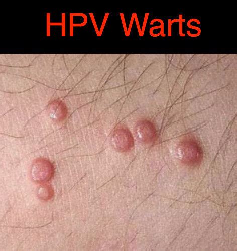 Hpv Genital Warts Ointment 4 Oz 118 Ml With Green Tea Extract Ebay