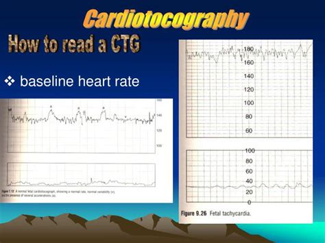 It is assessed by estimating the difference in bpm between the highest peak and lowest trough of fluctuation in one minute segments of the trace1. PPT - Fetal Monitoring & Wellbeing PowerPoint Presentation ...