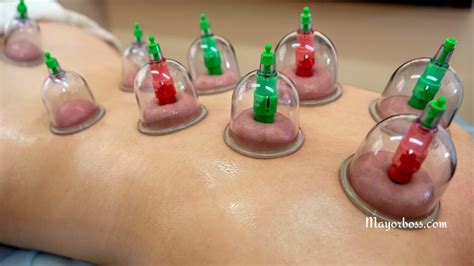 What Is Cupping Therapy Benefits Uses And Side Effects
