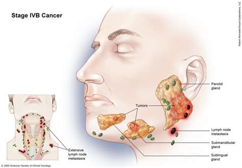 Salivary Gland Cancer Stages And Grades Cancernet